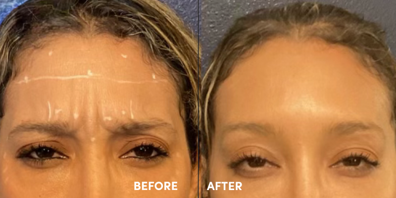 botox injections costa mesa